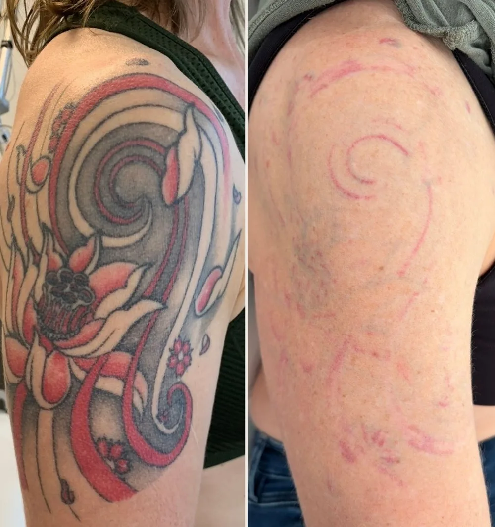 Avant / Après — détatouage d'un tatouage couleur sur l'épaule