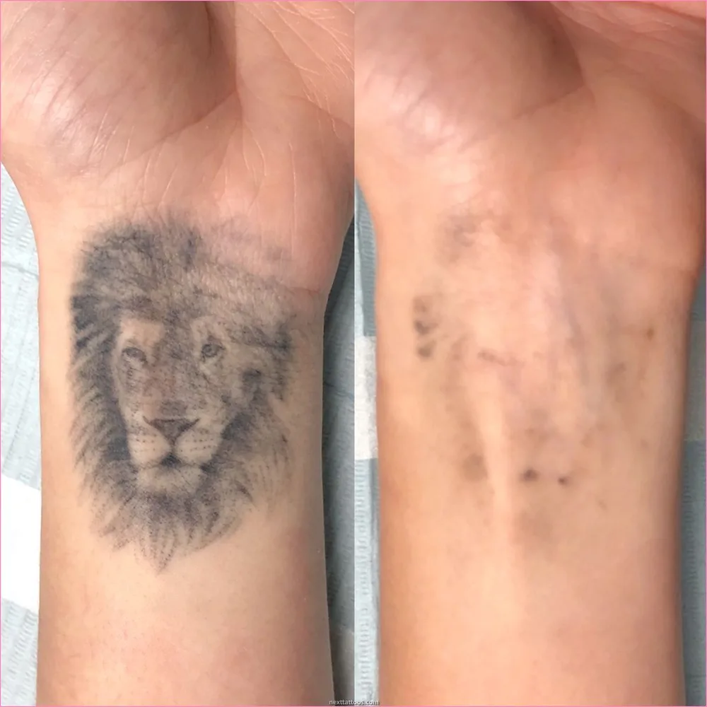 Avant / Après — détatouage d'un tatouage noir sur le poignet