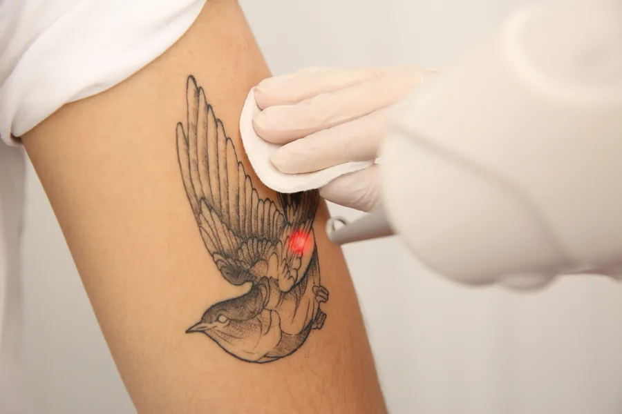 Séance de détatouage laser sur un tatouage